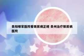 貴陽(yáng)哪家醫(yī)院看銀屑病正規(guī) 貴州治療銀屑病醫(yī)院