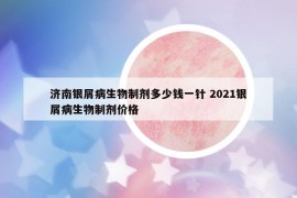 濟南銀屑病生物制劑多少錢一針 2021銀屑病生物制劑價格