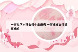 一歲以下小孩會(huì)得牛皮癬嗎 一歲寶寶會(huì)得銀屑病嗎