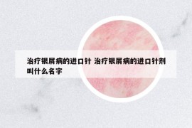 治療銀屑病的進(jìn)口針 治療銀屑病的進(jìn)口針劑叫什么名字