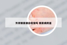 外陰銀屑病會癌變嗎 銀屑病陰道