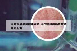 治療銀屑病用啥中草藥 治療銀屑病最有效的中藥配方