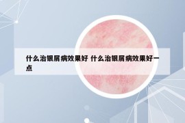什么治銀屑病效果好 什么治銀屑病效果好一點(diǎn)