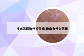 槐米怎樣治療銀屑病 槐米有什么藥用
