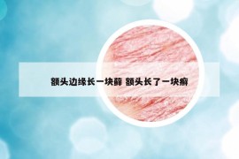 額頭邊緣長一塊蘚 額頭長了一塊癬