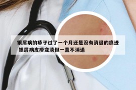 銀屑病的疹子過了一個月還是沒有消退的痕跡 銀屑病皮疹變淡但一直不消退