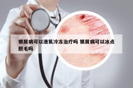 銀屑病可以液氮冷凍治療嗎 銀屑病可以冰點(diǎn)脫毛嗎