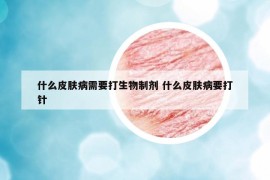 什么皮膚病需要打生物制劑 什么皮膚病要打針
