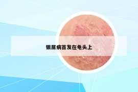 銀屑病首發(fā)在龜頭上
