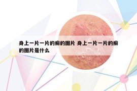 身上一片一片的癬的圖片 身上一片一片的癬的圖片是什么