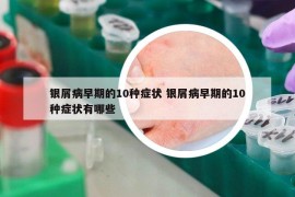 銀屑病早期的10種癥狀 銀屑病早期的10種癥狀有哪些