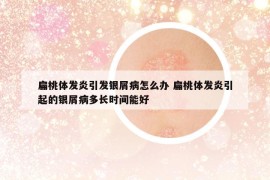 扁桃體發(fā)炎引發(fā)銀屑病怎么辦 扁桃體發(fā)炎引起的銀屑病多長(zhǎng)時(shí)間能好