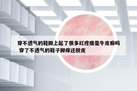 穿不透氣的鞋腳上起了很多紅疙瘩是牛皮癬嗎 穿了不透氣的鞋子腳癢還脫皮