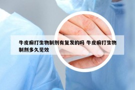 牛皮癬打生物制劑有復發(fā)的嗎 牛皮癬打生物制劑多久見效