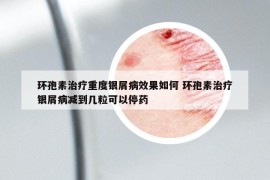 環(huán)孢素治療重度銀屑病效果如何 環(huán)孢素治療銀屑病減到幾?？梢酝Ｋ? /></a>		
		</figure>

		<header class=