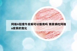 阿維A輕度牛皮癬可以服用嗎 銀屑病吃阿維a皮損的變化
