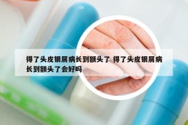 得了頭皮銀屑病長到額頭了 得了頭皮銀屑病長到額頭了會(huì)好嗎