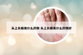 頭上長(zhǎng)癬用什么藥物 頭上長(zhǎng)癬用什么藥物好
