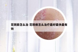 花斑蘚怎么治 花斑癬怎么治療最好最快最有效
