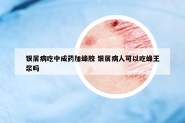 銀屑病吃中成藥加蜂膠 銀屑病人可以吃蜂王漿嗎