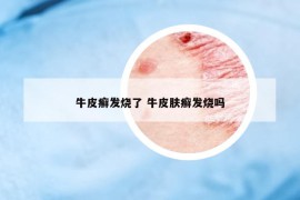 牛皮癬發(fā)燒了 牛皮膚癬發(fā)燒嗎