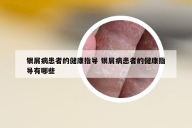 銀屑病患者的健康指導(dǎo) 銀屑病患者的健康指導(dǎo)有哪些