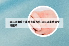 駐馬店治療牛皮癬有偏方嗎 駐馬店皮膚病?？漆t(yī)院