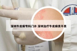 深圳牛皮癬專科門診 深圳治療牛皮癬貴不貴
