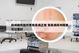 鄭州哪所醫(yī)院看銀屑病正規(guī) 銀屑病鄭州哪里可以看好