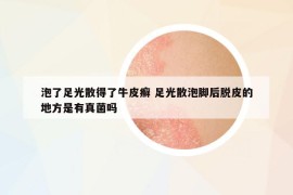 泡了足光散得了牛皮癬 足光散泡腳后脫皮的地方是有真菌嗎