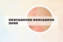 銀屑病引起腿腫的原因 銀屑病引起腿腫的原因有哪些