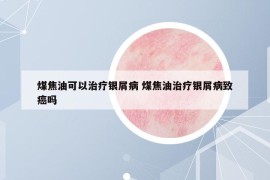 煤焦油可以治療銀屑病 煤焦油治療銀屑病致癌嗎