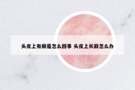 頭皮上有癬是怎么回事 頭皮上長蘚怎么辦