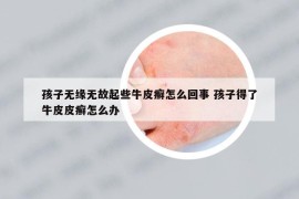 孩子無緣無故起些牛皮癬怎么回事 孩子得了牛皮皮癬怎么辦