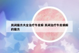 民間偏方大全治療牛皮癬 民間治療牛皮病癬的偏方