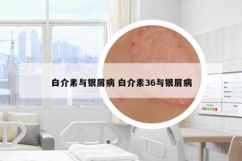 白介素與銀屑病 白介素36與銀屑病