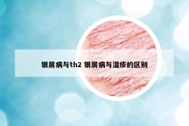 銀屑病與th2 銀屑病與濕疹的區(qū)別