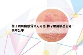 得了銀屑病感覺生無可戀 得了銀屑病感覺老天不公平