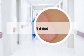牛皮癬顏