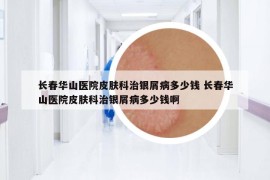 長春華山醫(yī)院皮膚科治銀屑病多少錢 長春華山醫(yī)院皮膚科治銀屑病多少錢啊
