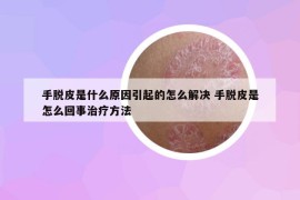 手脫皮是什么原因引起的怎么解決 手脫皮是怎么回事治療方法
