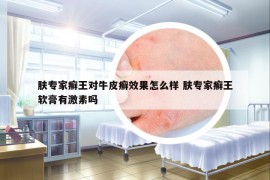 膚專家癬王對牛皮癬效果怎么樣 膚專家癬王軟膏有激素嗎