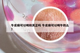 牛皮癬可以喝和其正嗎 牛皮癬可以喝牛奶么?