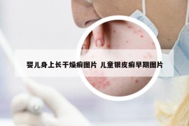 嬰兒身上長干燥癬圖片 兒童銀皮癬早期圖片