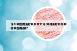 徐州中醫(yī)院治療銀屑病如何 徐州治療銀屑病哪家醫(yī)院最好