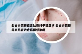 曲安奈德新霉素貼膏對(duì)于銀屑病 曲安奈德新霉素貼膏治療真菌感染嗎