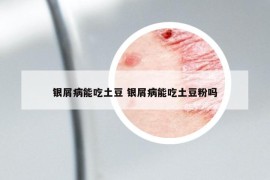 銀屑病能吃土豆 銀屑病能吃土豆粉嗎