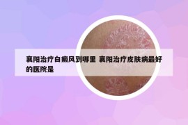襄陽(yáng)治療白癜風(fēng)到哪里 襄陽(yáng)治療皮膚病最好的醫(yī)院是