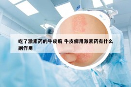 吃了激素藥的牛皮癬 牛皮癬用激素藥有什么副作用