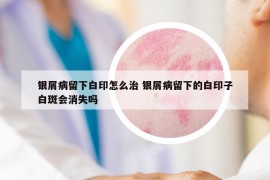 銀屑病留下白印怎么治 銀屑病留下的白印子白斑會(huì)消失嗎